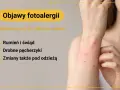 Objawy fotoalergii: rumień, świąd, drobne pęcherzyki pojawiające się po słońcu, nawet pod ubraniem.