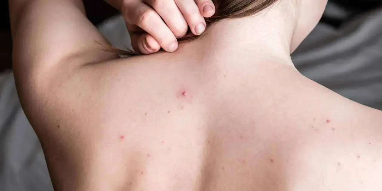 Widoczne są **blizny po trądziku na plecach** i kilka zaczerwienionych krostek. Dłoń delikatnie dotyka karku.