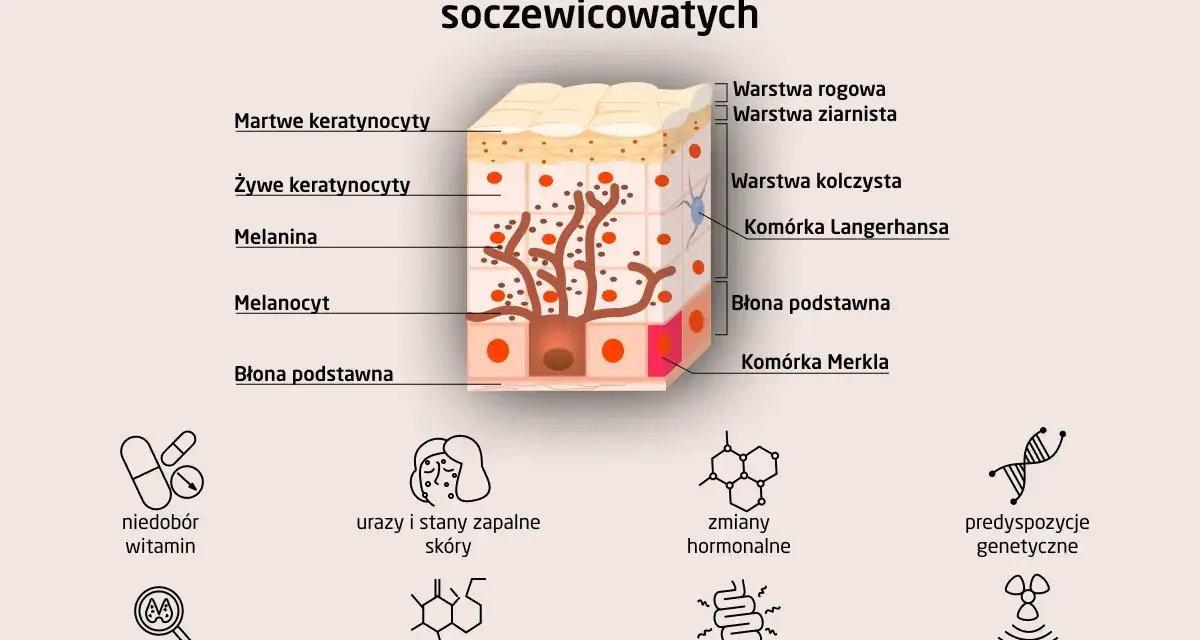 Schemat przedstawia budowę skóry i przyczyny powstawania plam soczewicowatych: niedobory witamin, urazy, zmiany hormonalne, predyspozycje genetyczne.