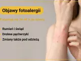 Objawy fotoalergii: rumień, świąd, drobne pęcherzyki pojawiające się po słońcu, nawet pod ubraniem.