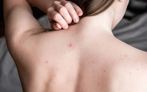 Widoczne są **blizny po trądziku na plecach** i kilka zaczerwienionych krostek. Dłoń delikatnie dotyka karku.