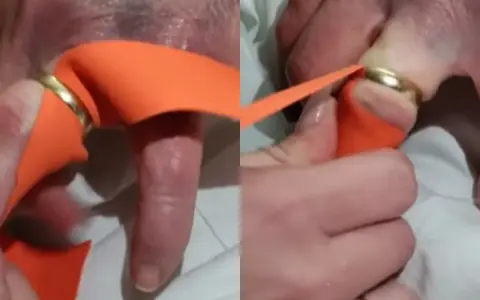 Pomoc w zdjęciu za ciasnej obrączki z palca przy użyciu pomarańczowej taśmy.
