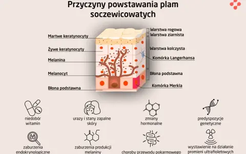 Schemat przedstawia budowę skóry i przyczyny powstawania plam soczewicowatych: niedobory witamin, urazy, zmiany hormonalne, predyspozycje genetyczne.
