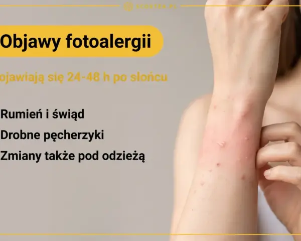Objawy fotoalergii: rumień, świąd, drobne pęcherzyki pojawiające się po słońcu, nawet pod ubraniem.