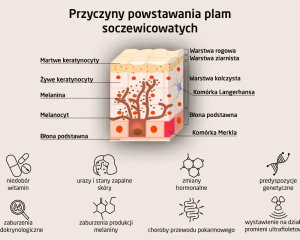 Schemat przedstawia budowę skóry i przyczyny powstawania plam soczewicowatych: niedobory witamin, urazy, zmiany hormonalne, predyspozycje genetyczne.