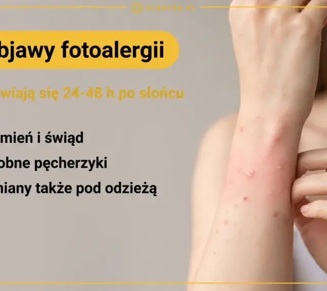 Objawy fotoalergii: rumień, świąd, drobne pęcherzyki pojawiające się po słońcu, nawet pod ubraniem.