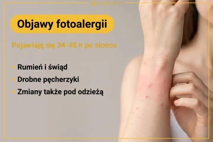 Objawy fotoalergii: rumień, świąd, drobne pęcherzyki pojawiające się po słońcu, nawet pod ubraniem.