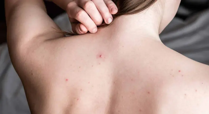 Widoczne są **blizny po trądziku na plecach** i kilka zaczerwienionych krostek. Dłoń delikatnie dotyka karku.