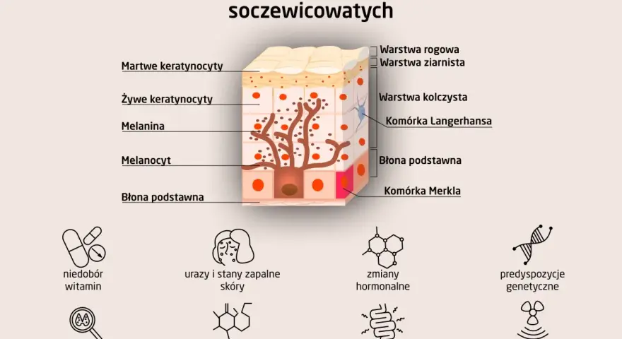Schemat przedstawia budowę skóry i przyczyny powstawania plam soczewicowatych: niedobory witamin, urazy, zmiany hormonalne, predyspozycje genetyczne.
