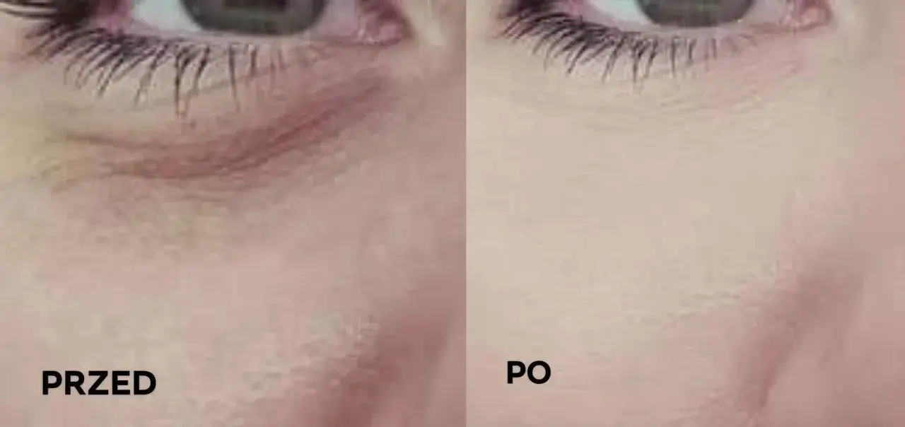 Przed i po: zmęczona twarz pod oczami staje się gładsza i jaśniejsza.